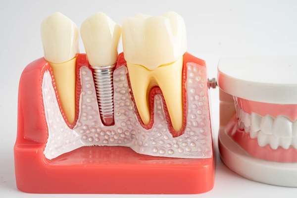 How Dental Implants Improve Oral Health And Function