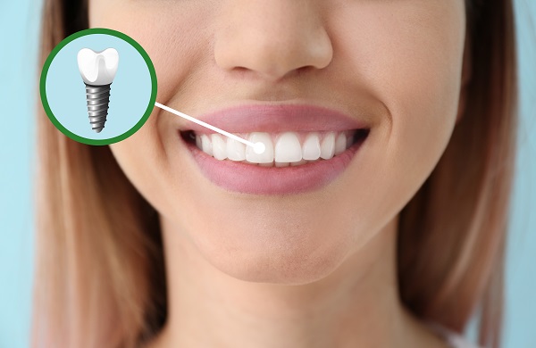 Three Benefits Of Dental Implants