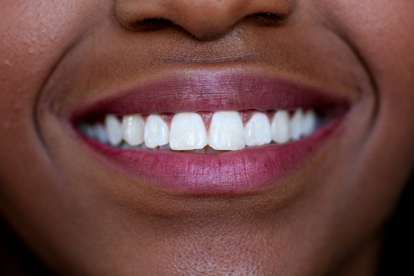 Teeth Whitening    : Your Guide To A Dazzling Smile